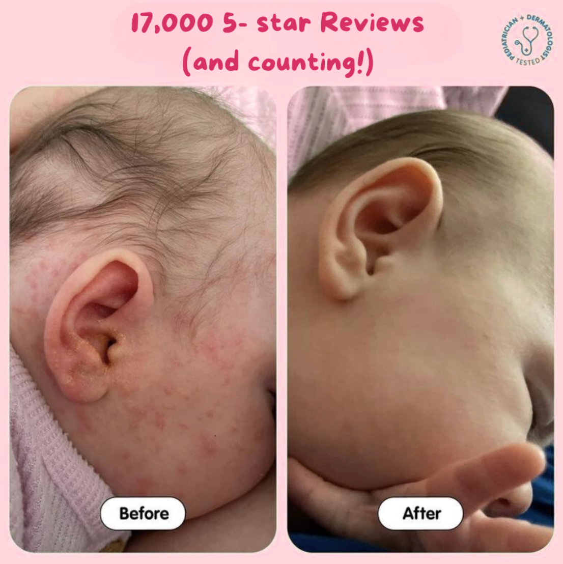 Eczema Beef Tallow Balm