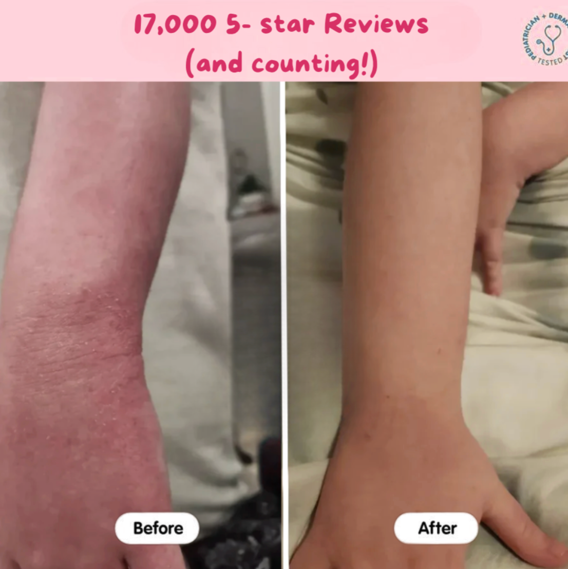 Eczema Beef Tallow Balm
